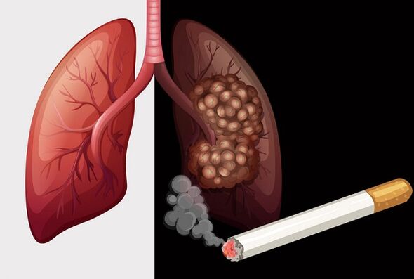pulmões de fumante e pulmões saudáveis