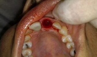 o local do dente extraído